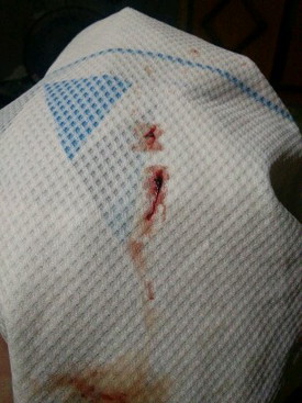 เลือดออก