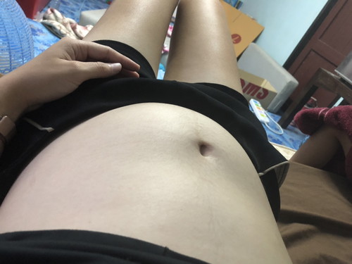 ท้องแตก