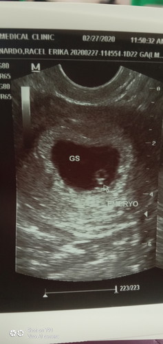 wala pang heart beat si baby