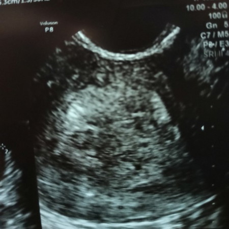 positif 2garis tp saat USG transvaginal baru penebalan dinding rahim