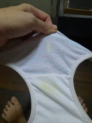 Vaginal discharge