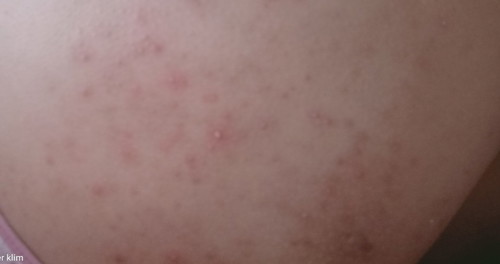 Rashes at 31 weeks