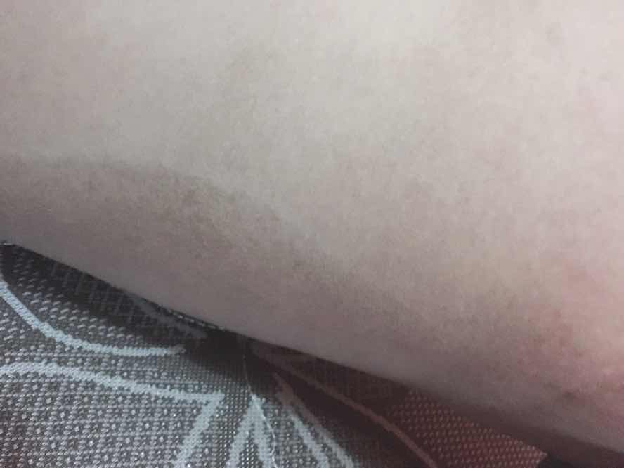 Streckmark atau bukan