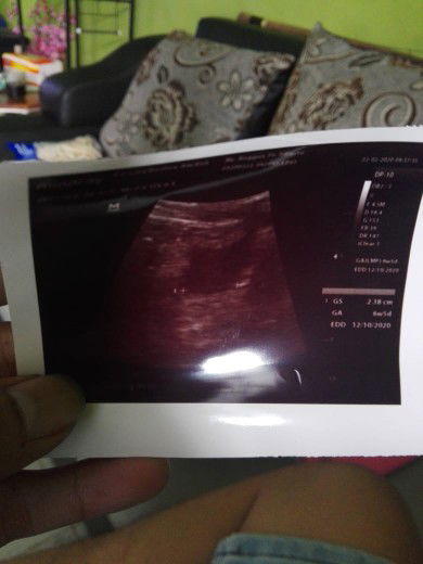 6 weeks 5 day baru terlihat kantong