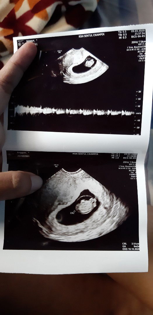 usg transvaginal 9 week