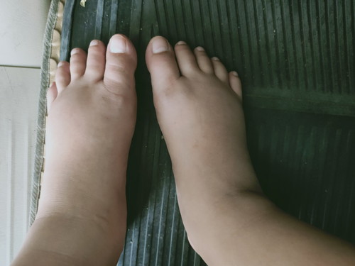 บ้านไหนเท้าบวมบ้าง