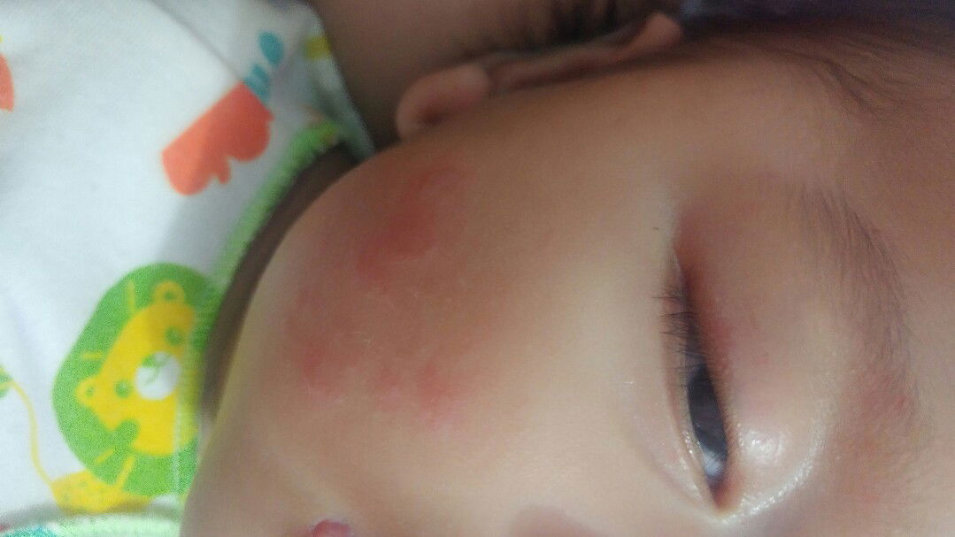 pipi bayi memerah