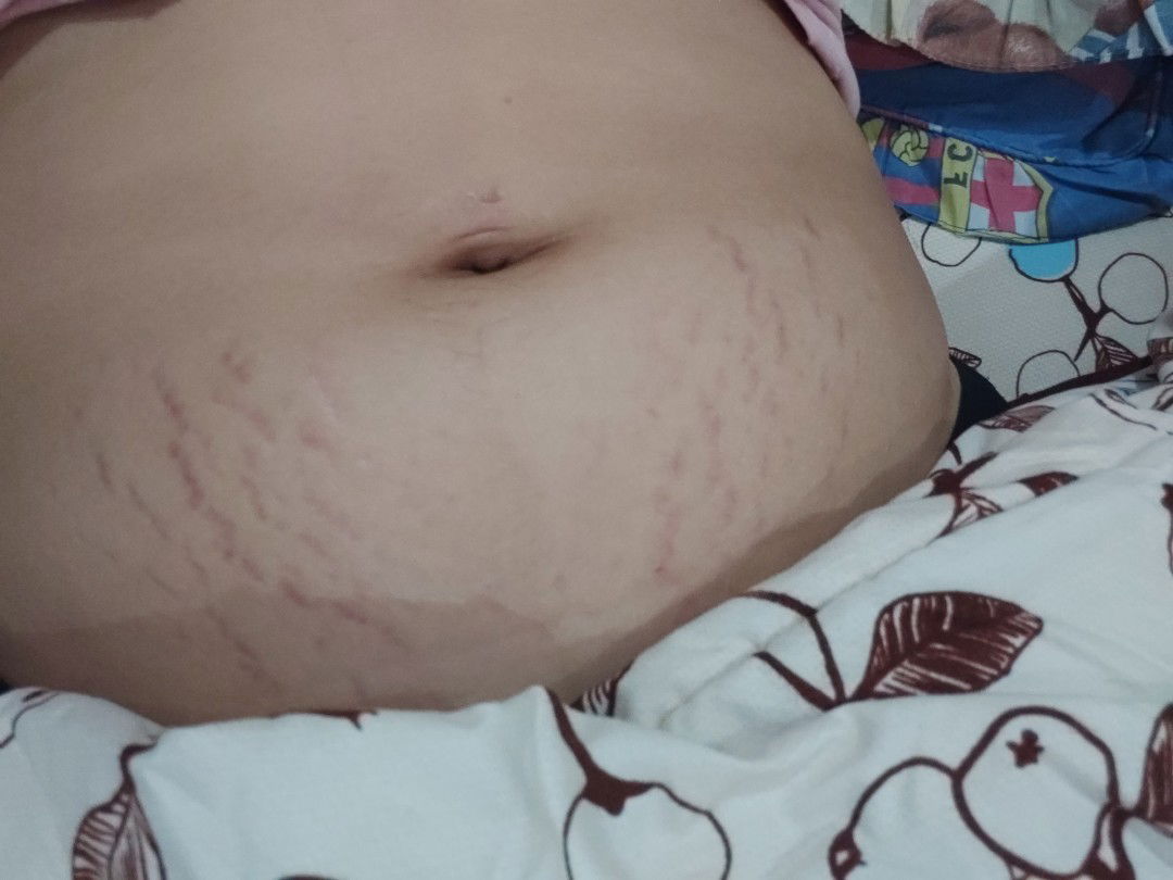 strech mark (15minggu 4hari)