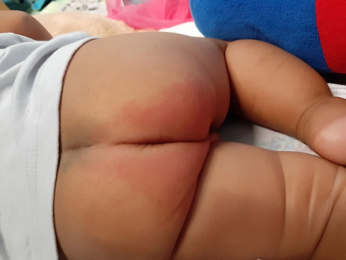 rashes
