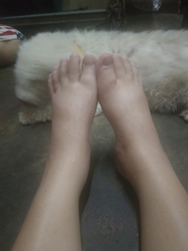 บวม