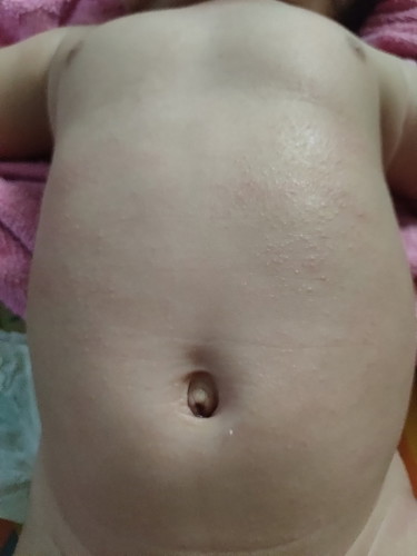 perut baby berbintik