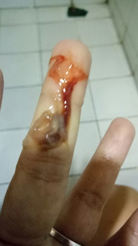 polyp , with discharge now 6mos preggy