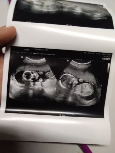 สรุปได้ ลูกชายค่ะ 18 สัปดาห์ 6วัน