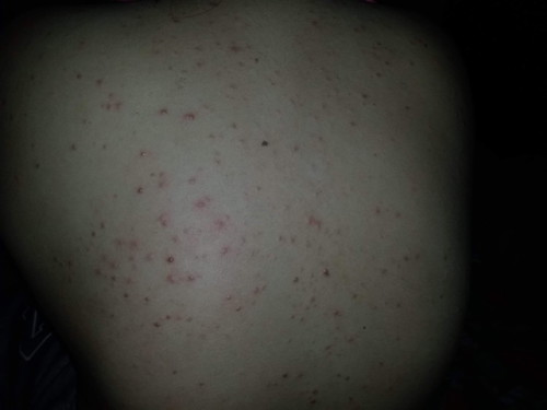 madaming pimples sa likod at leeg.