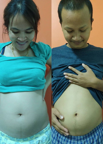 ท้องแฝด