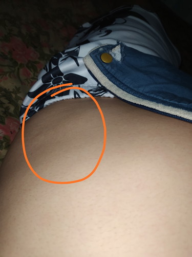 Malambot na parang bukol sa right side