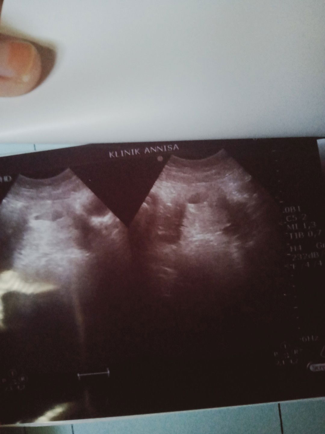 hamil uk 12 minggu , usg masih kantong