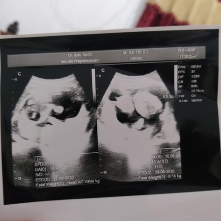 hasil foto usg kurang jelas