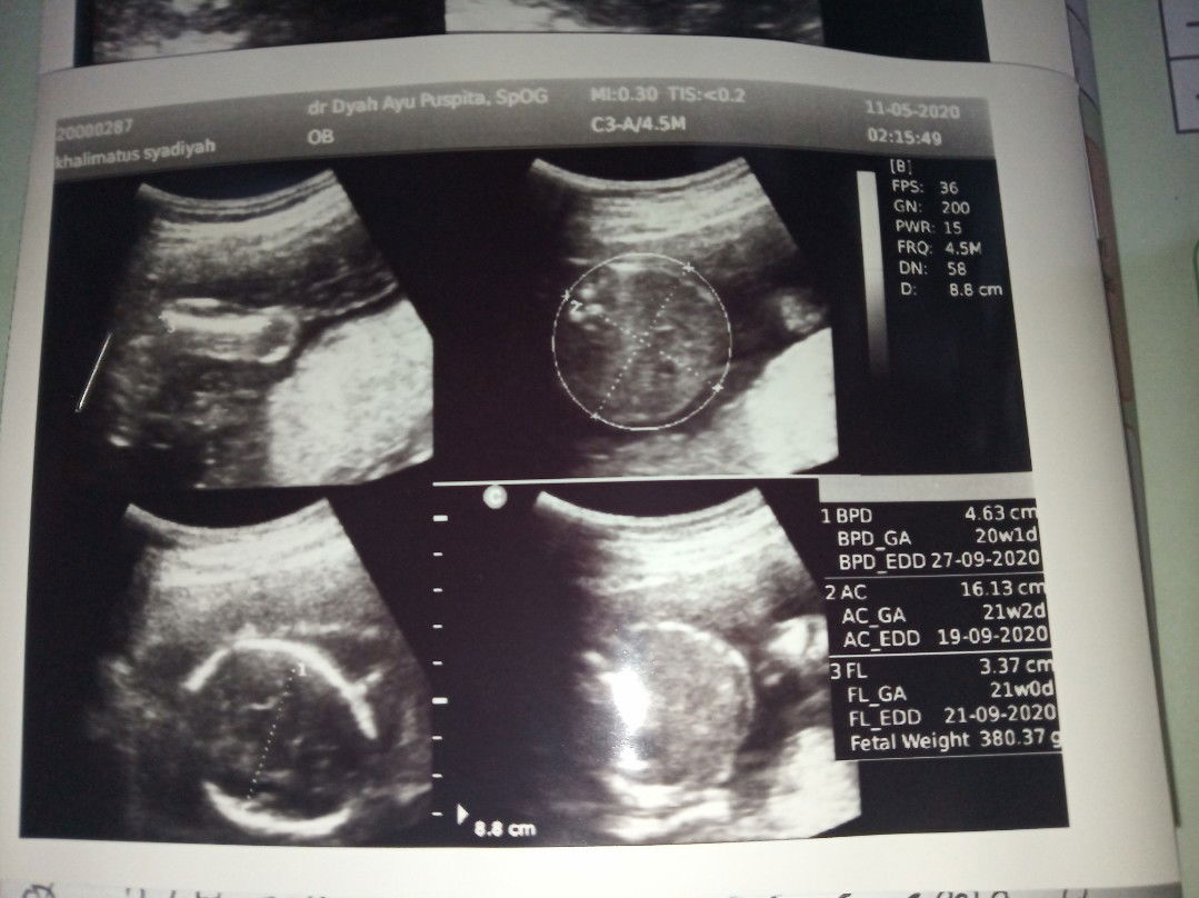USG 21 Weeks