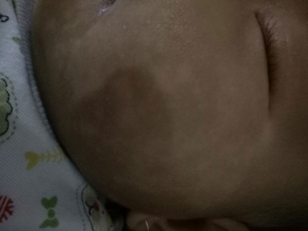 Bercak Putih pada Pipi Bayi