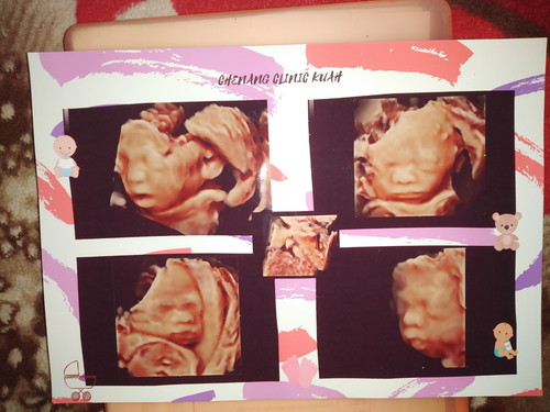 Baby Scan 5D