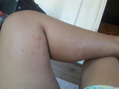 allergy?