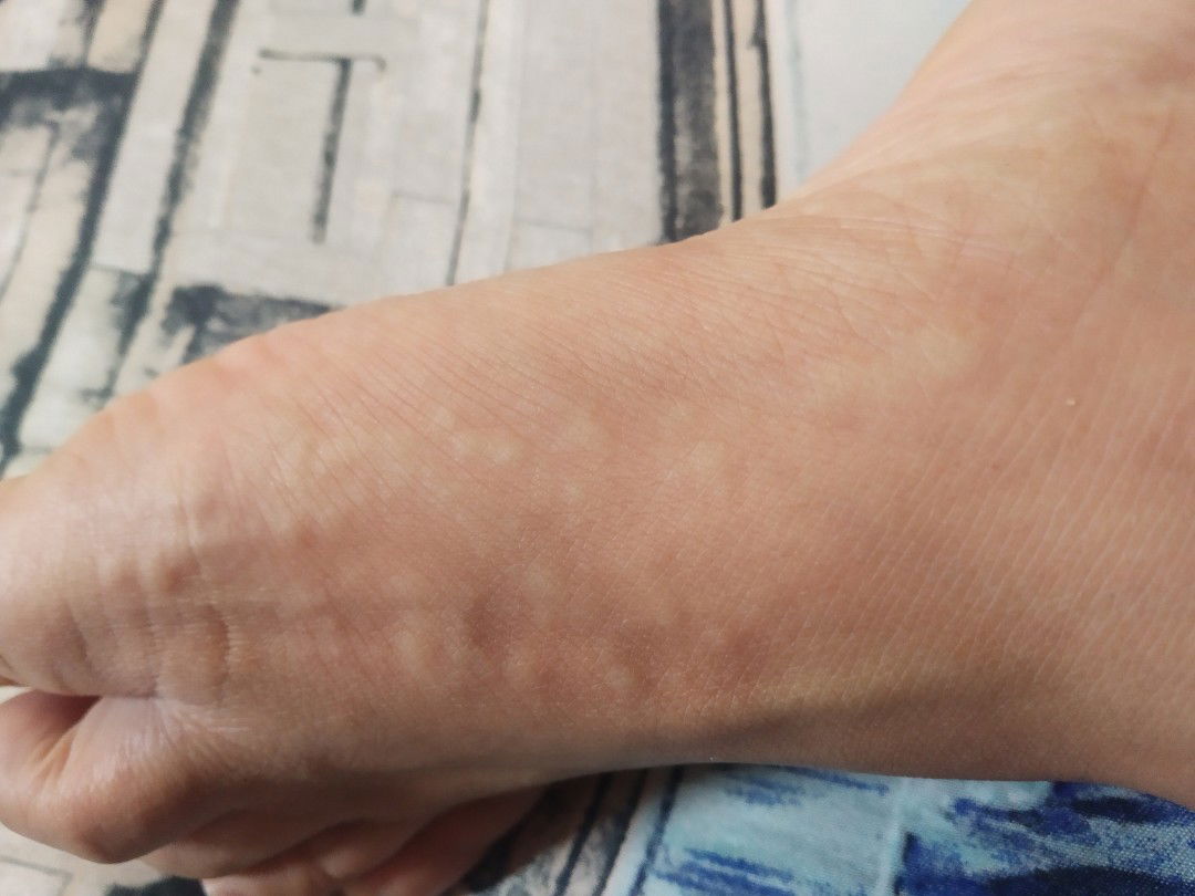 Pinggiran Telapak Kaki Gatal Parah