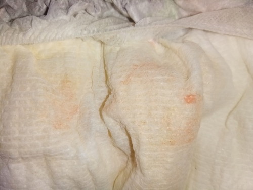 blood urine of baby