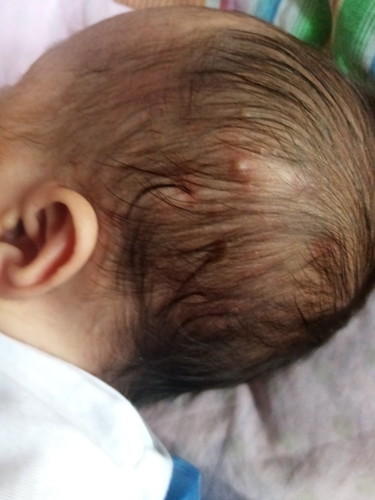 butlig sa likod ng ulo ni baby