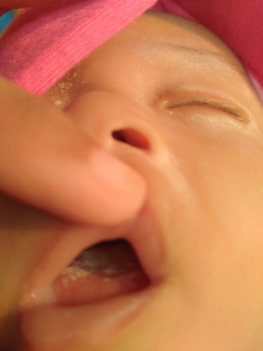 lidah bayi umur 2 bulan ada putih2 nya