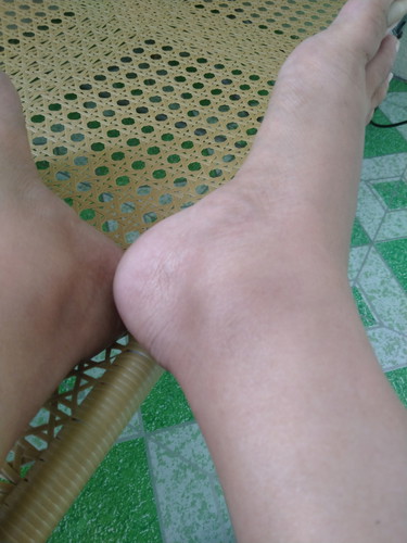 Feet and ankle swelling