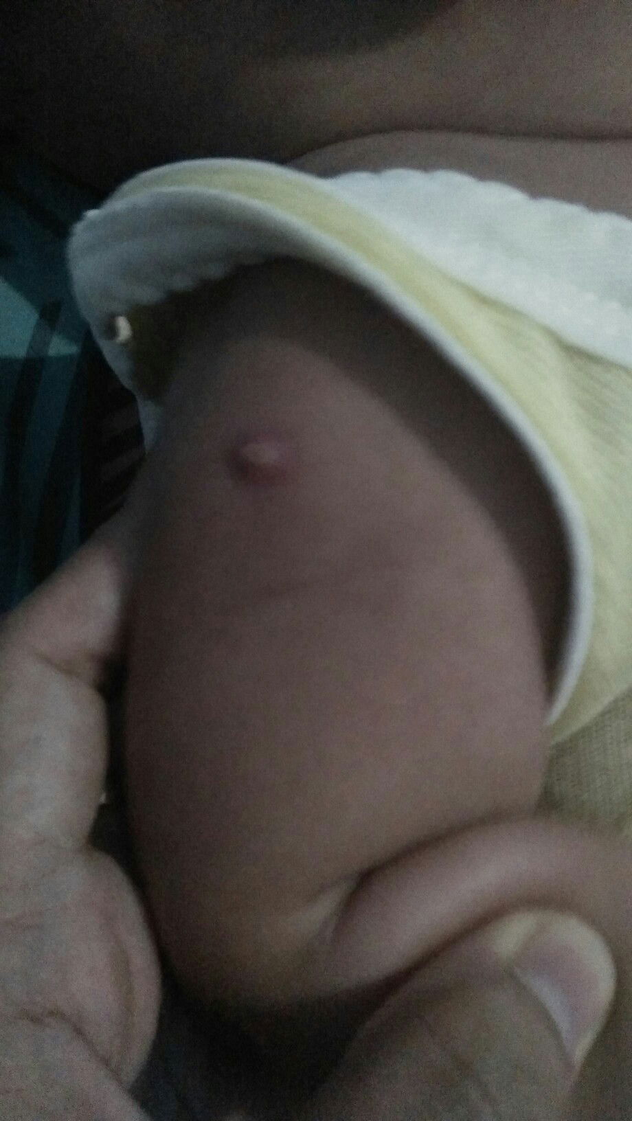 bekas suntik imunisasi ada benjolan merah kayak jerwat