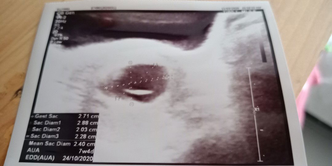 UK 12w tapi hasil USG 7w vonis BO