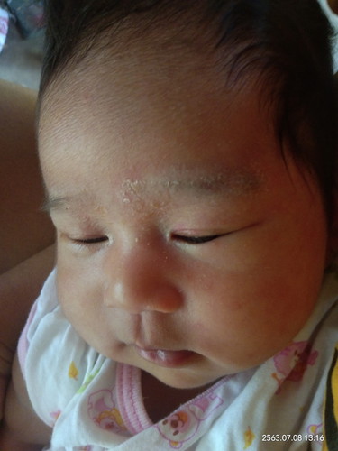 คิ้วน้องเป็นคล้ายๆคิ้วลอก