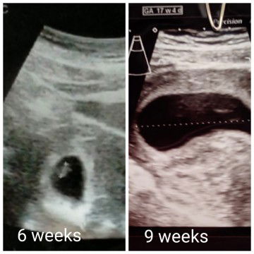 hamil 9 minggu janin tidak terlihat di usg. padahal saat 6 minggu janin sudah terlihat