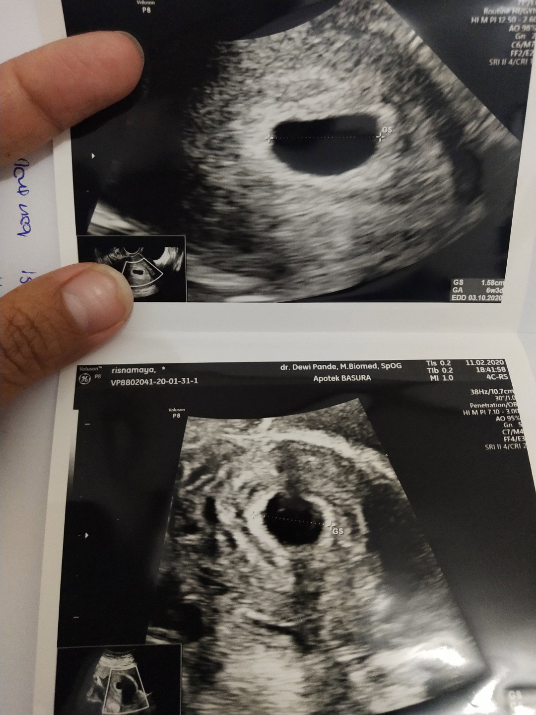 Aslm..Bun ad yg sama ga y ama saya usia 6w3d bru ad kantungnya ajah??