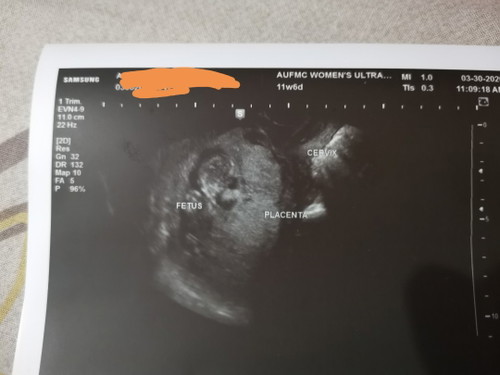partial h-mole pregnancy
