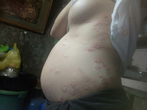 Prosiasis? 26 weeks pregnant
