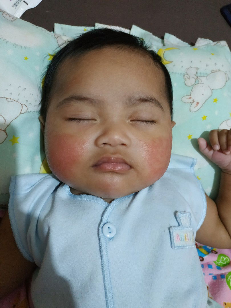 ruam pipi yang timbul hilang