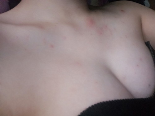 pimples