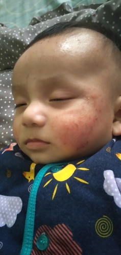 Eksim pada bayi usia 4 bulan, bgmn cara mengatasinya ya bun/moms?