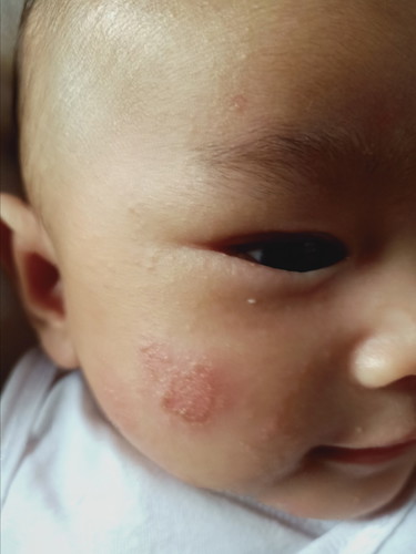 face rash