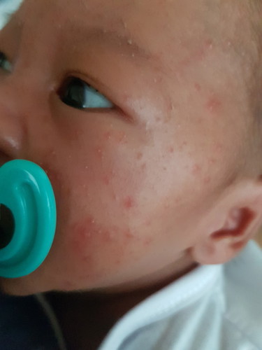 baby pimples