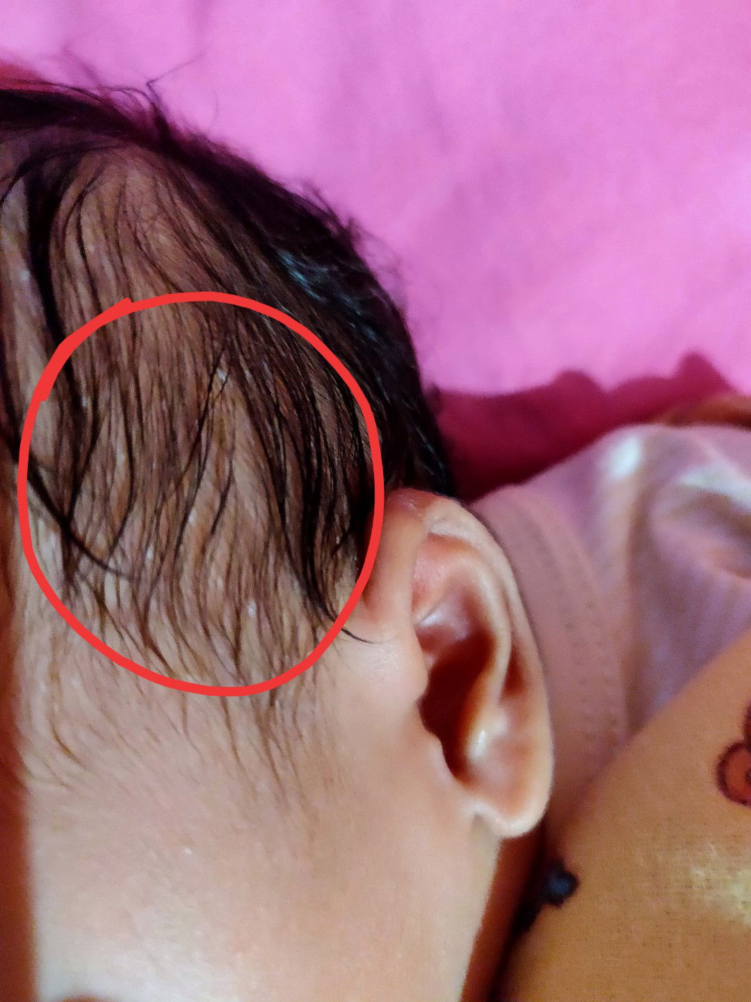 bruntusan di kulit kepala