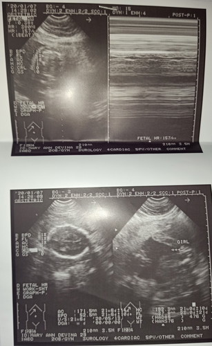 7 months preggy po umitim mga kilikili singit leeg ko dede ko din marami nag sasabi na lalaki anak ko pero ultrasound ko is baby girl nag woworry ako bka mali ultrasound sakin dahil sa mga sinasabi ng kapitbahay...
