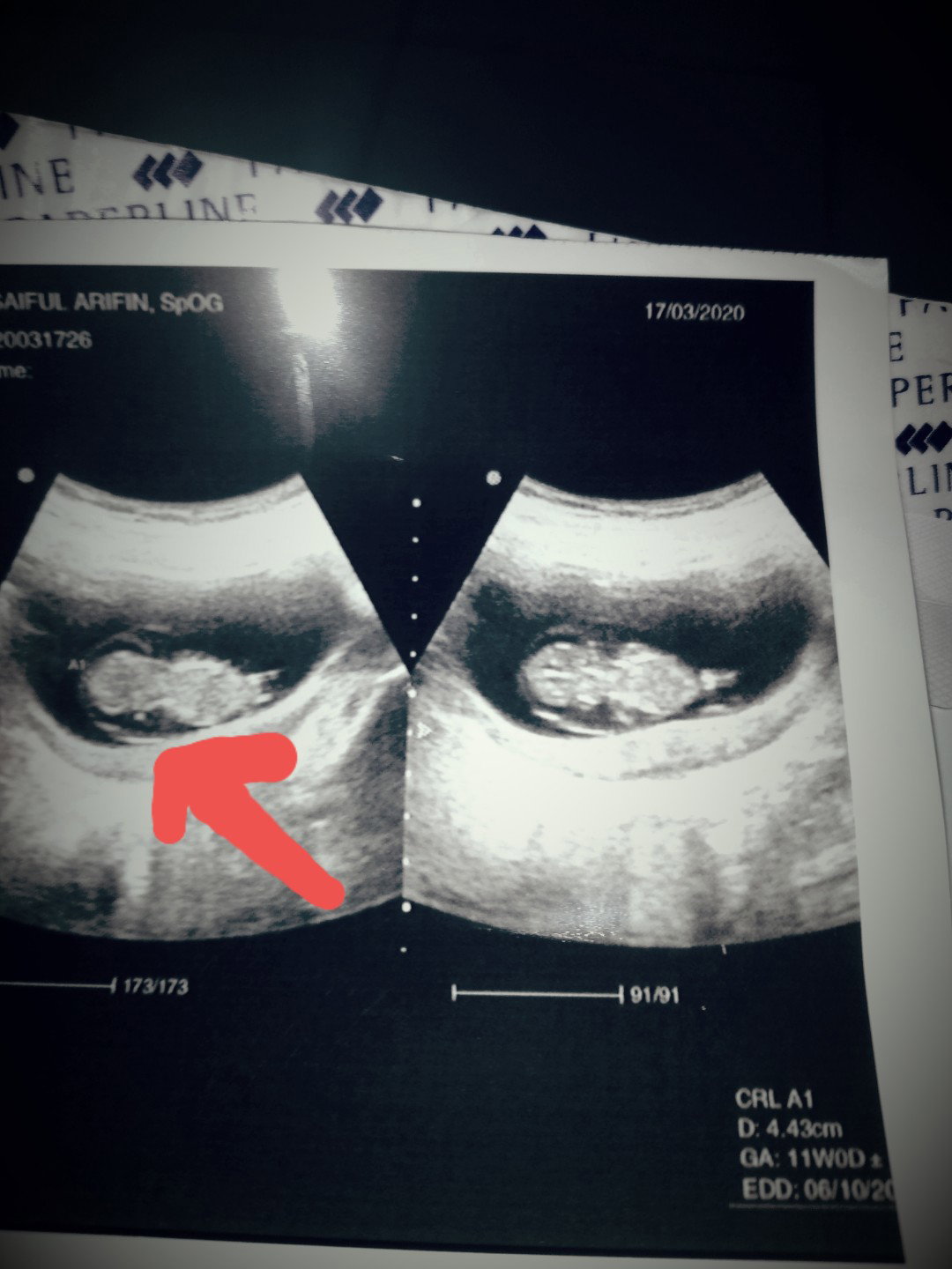 cairan di dalam kantung kehamilan