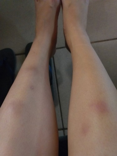 Normal lang po kaya to sa buntis?