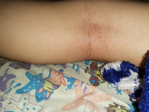 Rash