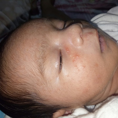 Newborn Rashes