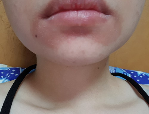 skin problem sa face during pregnancy